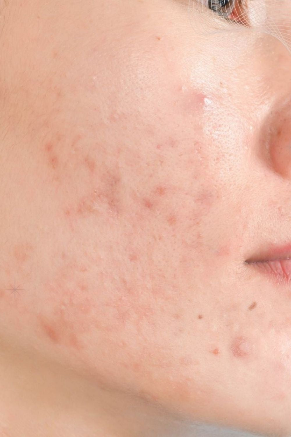 Hyperpigmentation routine